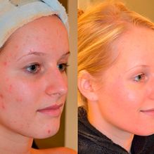 antes y después tratamiento facial en pamplona